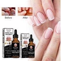 [한정특가 1+1] 조갑사상균증 개선 발톱 에센스 대용량 50ml, 2병