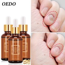 발가락통증 각질제거oedo 발 손톱 곰팡이 제거 fungal nail treatment essential oil anti 감염 paronychia onychomycosis han, 협력사