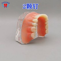치과 임플란트 치아모형 교구 교육 관리 구강 과학실 치과 치위생 틀니 연구 잇몸, 스파이크 2개 심기 복원