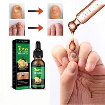 BT 손발톱 무좀치료제 생강 진균 리페어에센스 발톱 케어제 발톱연화 무좀 관리, 30ml, 2개
