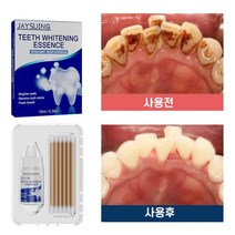 치아 미백 셀프 치아미백제 화이트닝겔 치아 얼룩 치석제거, 1개, 10ml