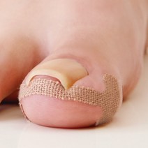 발 발톱 내성 테이프 보호 케어 관리 밴드 테이핑 파고드는 교정 엄지 발가락 패치 풋 펴기 치료 자가 간편한 파고들때 테잎, 1개