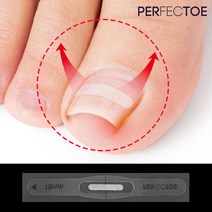 퍼펙토 내성발톱 치료 교정 팁 의료기기 세트, 16mm TOOL세트