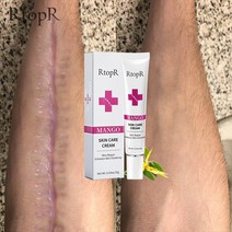 하이라이터 피부 흉터 제거 크림 얼굴 페이드 여드름 반점 치료 블랙헤드 화이트닝 스트레치 마크 뷰티