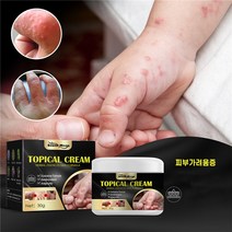 피부가려움증 크림 한포진 지루성피부염 습진연고 여드름 모낭염연고, 3개