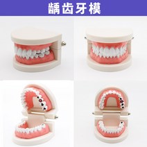 치아모형 인체모형도 치과기구 실리콘몰드 인체모형 양치교구 재료상, 충치 모델