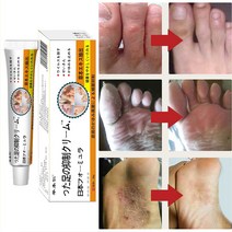 BT 무좀약 연고 발톱무좀 치료 발가락 가려움 연고 발냄새 제거, 1개, 20ml