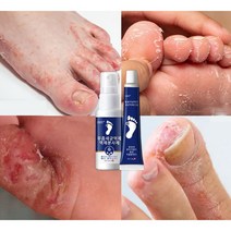 무좀약 스프레이 발톱무좀 치료 발냄새 제거 발각질제거 발가려움 연고 30ML+15g, 30ml+15g*1개
