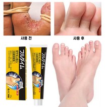 무좀약 연고 스프레이 발톱무좀 치료 발냄새 제거 발각질제거 발가려움 연고, 20g, 3개, 1개