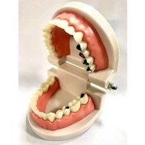 치아모형 모델 교육 모델 틀니 모델 구강 장비 재료 도구 연습 데모, 검은색 단순 충치 치과 모델