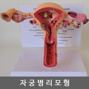 자궁병리모형 자궁모형 난소모형 병리적해부모형