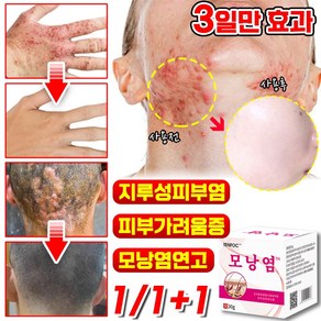 1/1+1 [즉효] 모낭염 연고 지루성피부염 피부가려움증 여드름 완화 크림