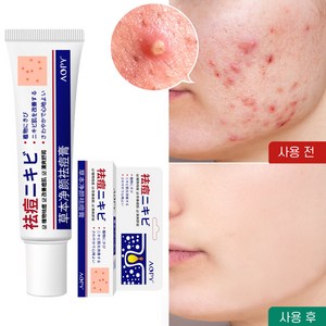 여드름 연고 여드름 색소침착 흉터 치료 연고 여드름 방지 미백 크림, 5개, 20g