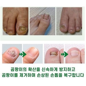 {일본 수입} 100% 두꺼운 손발톱 곰팡이 제거오래된 회색 손톱 제거기타 모든 손톱 트리트먼트 LY023, 2개, 20g