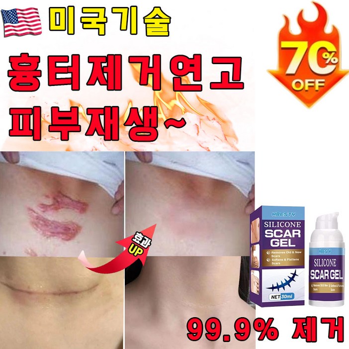 독일기술 111 흉터제거 연고 제왕절개 화상흉터 재생크림 수술 상처 흉터 연고, 1개