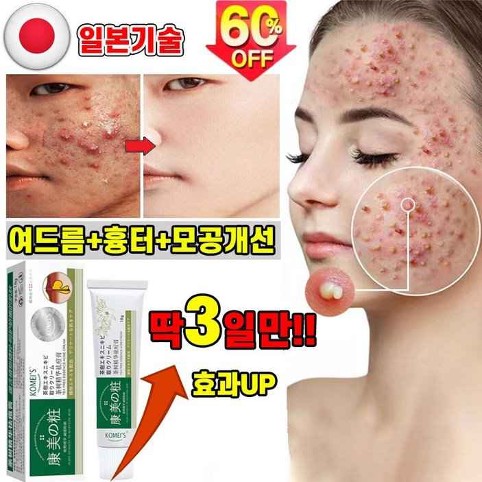 [효과보장] 일본기술 여드름 연고 흉터 치료 제거 리페어 연고 문제피부 자국 모공 진정 피지케어 크림