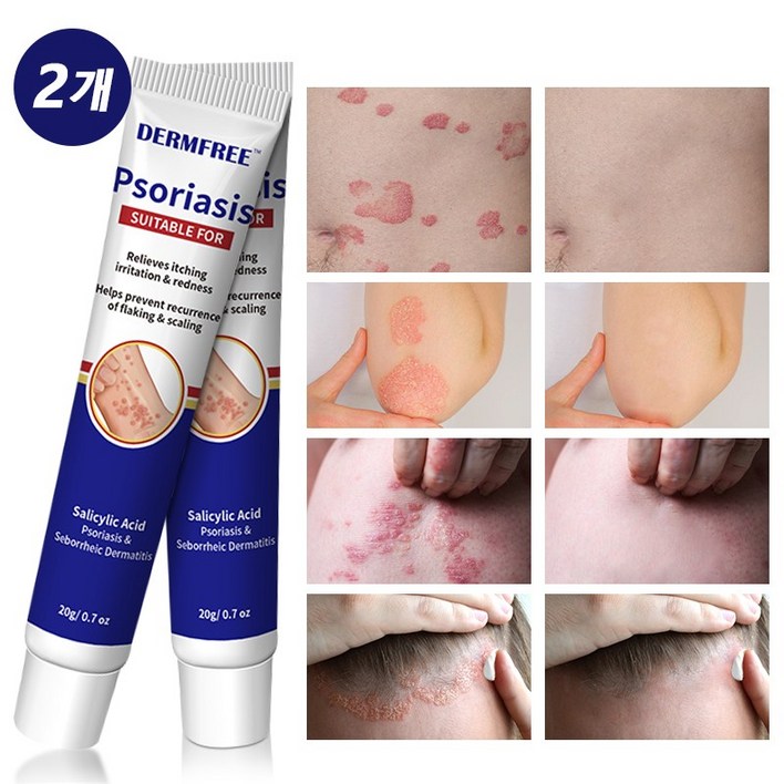 Dermfree 건선크림 피부 건조 가려움 케어, 20ml, 2개 Dermfree 건선크림 피부 건조 가려움 케어, 20ml, 2개