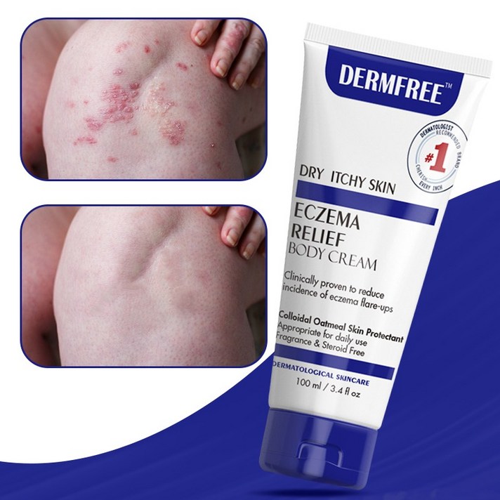 DERMFREE 건선 연고 습진 두드러기 피부 건선 피부염 피부 가려움 아토피 피부염 모낭염 지루성 피부염, 2개, 100ml