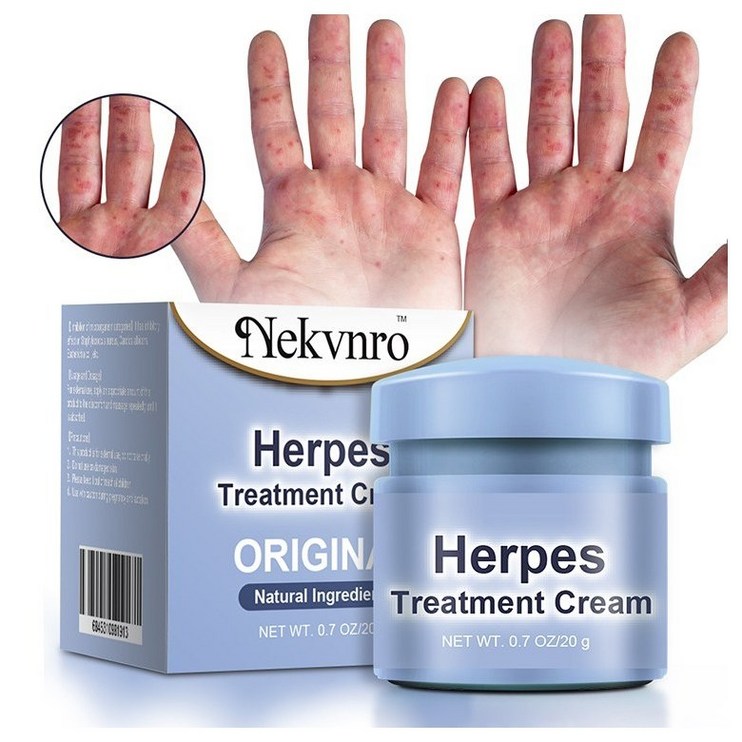 Nekvnro 건선 진고포지 루성피부염 접촉피부염 두피 건선 피부가려움증, 2개, 20g Nekvnro 건선 진고포지 루성피부염 접촉피부염 두피 건선 피부가려움증, 2개, 20g